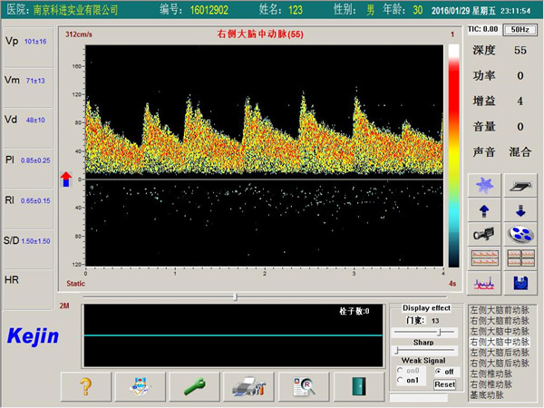 經顱多普勒PW模式下單窗口檢測界面