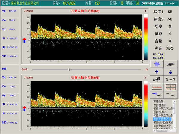 經顱多普勒單通道,雙深度界面 經顱多普勒單通道,雙深度界面