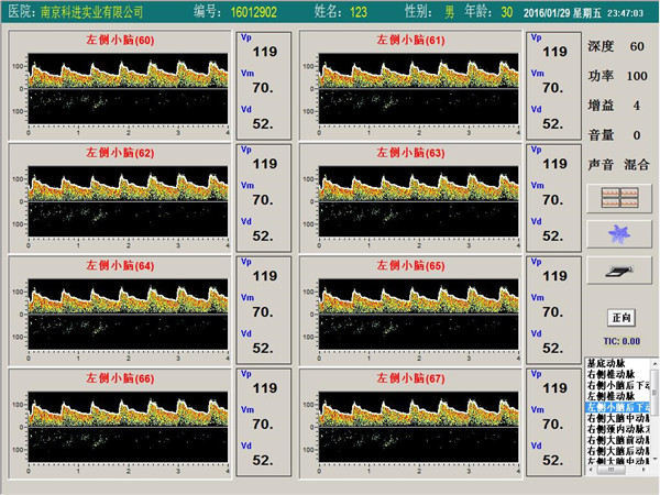 經顱多普勒單通道,八深度界面 經顱多普勒單通道,八深度界面