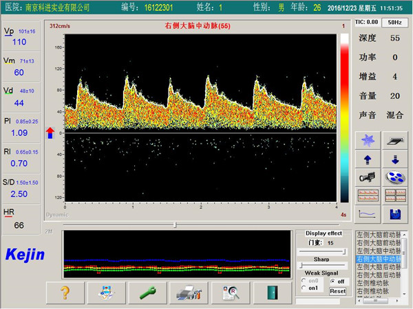 1533190554761941.jpg 超聲經顱多普勒血流分析儀檢測界面.jpg