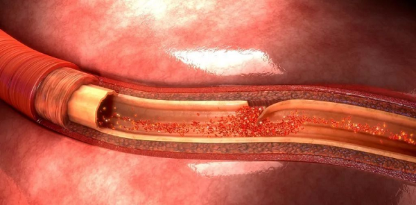 頸動脈夾層是中青年腦卒中受檢者重要誘因 頸動脈夾層是中青年腦卒中受檢者重要誘因