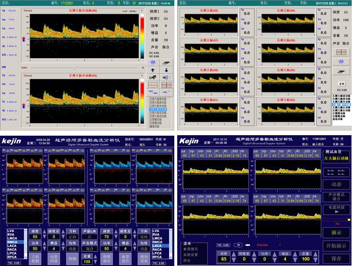 TCD血管定位技術實現自動搜索血管信號