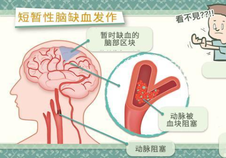 短暫性腦缺血是什么 經顱多普勒可確診 短暫性腦缺血是什么 經顱多普勒可確診