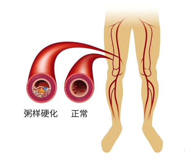 如何減緩腦動脈粥樣硬化的發生和發展