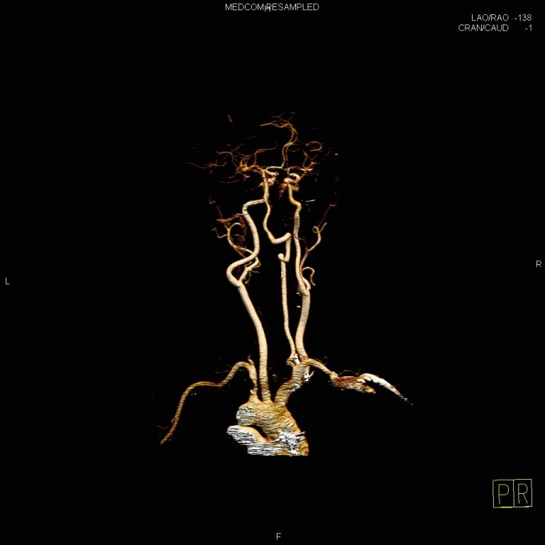 鎖骨下動(dòng)脈盜血綜合征是怎樣一種疾病 鎖骨下動(dòng)脈盜血綜合征是怎樣一種疾病